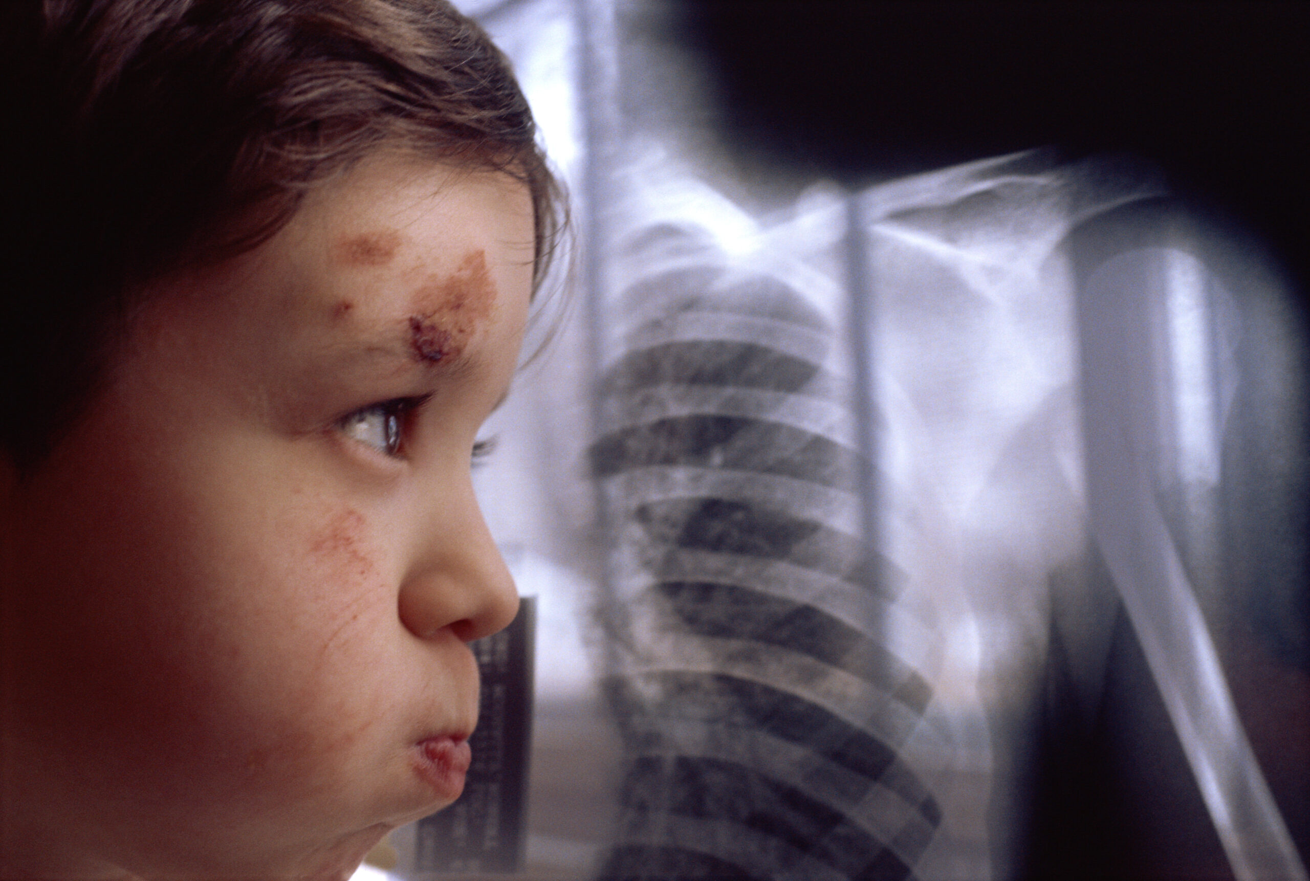 Abused Child with X-Rays